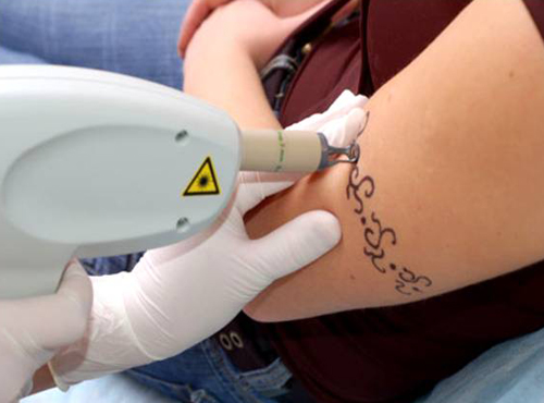 Как можно удалить татуировку